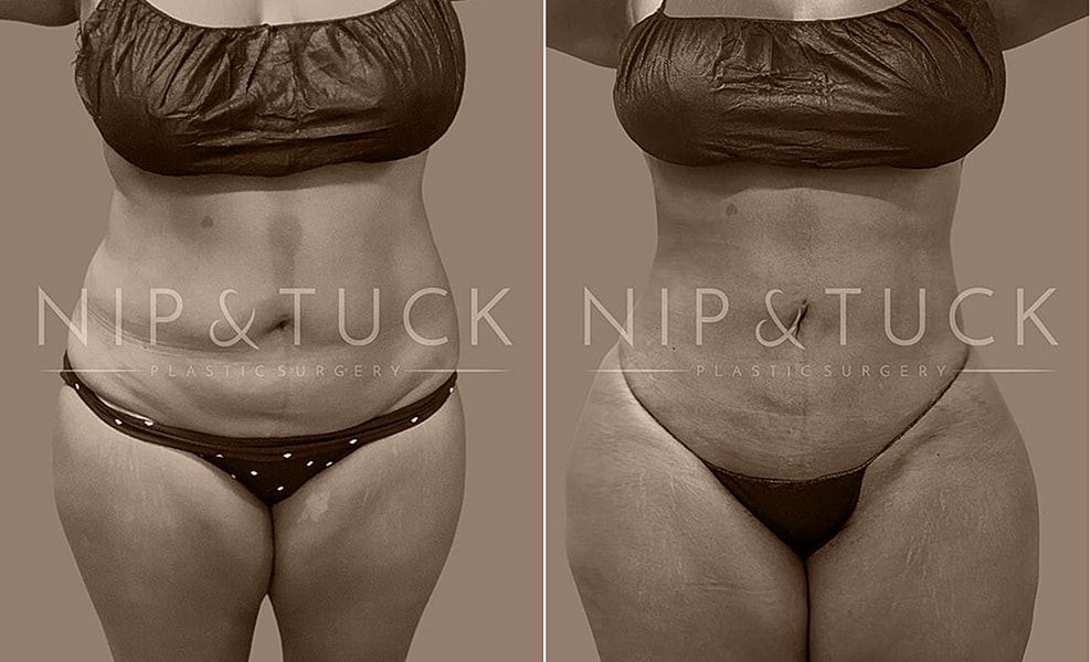 Before and after plastic surgery transformation images.