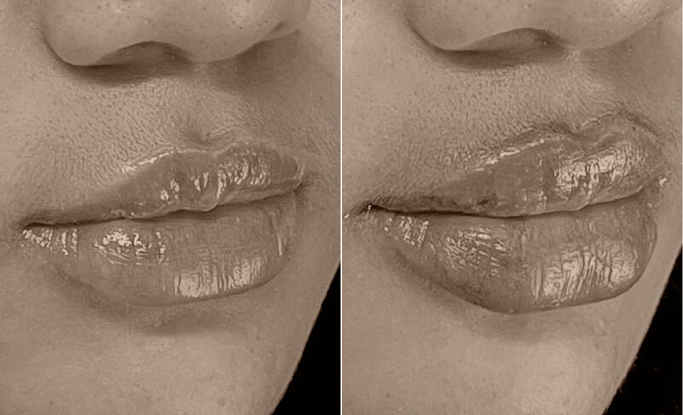 Before and after lip enhancement comparison.