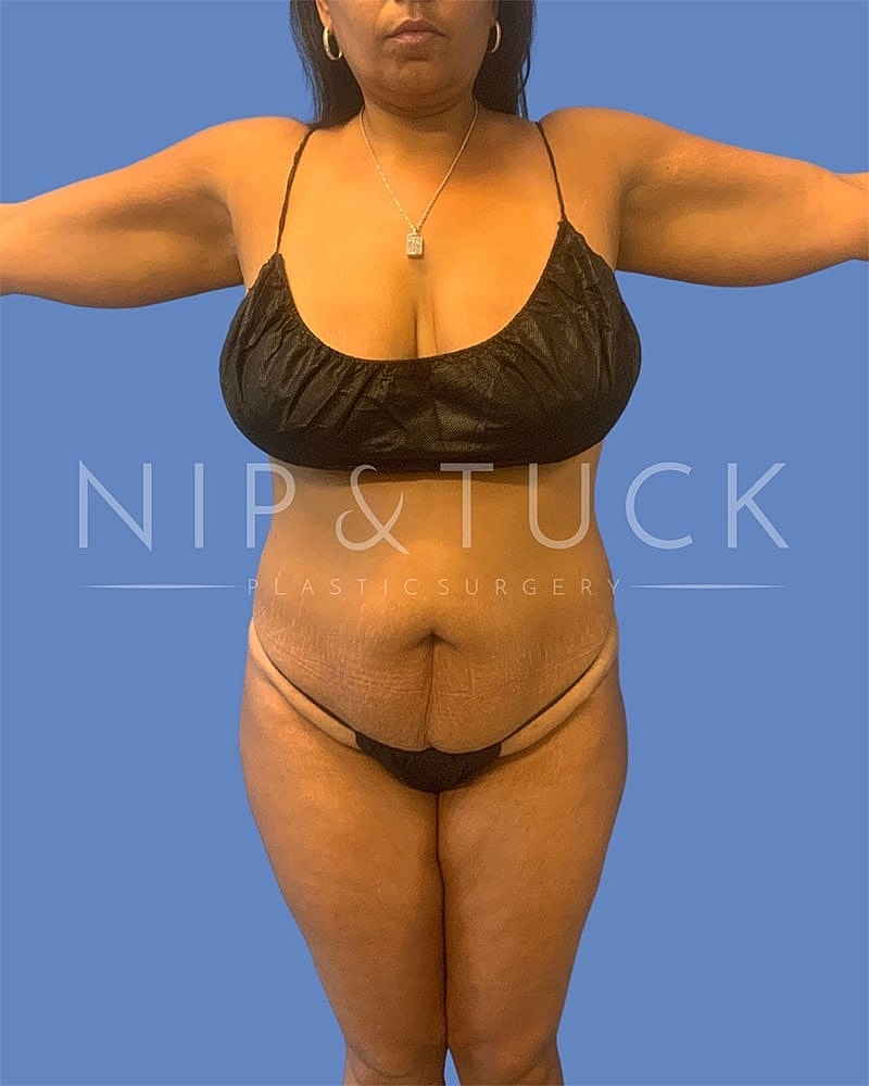 Mommy Makeover Before & After