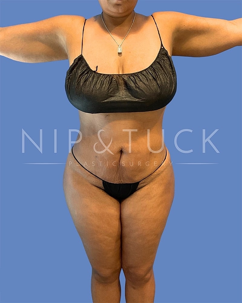 Mommy Makeover Before & After