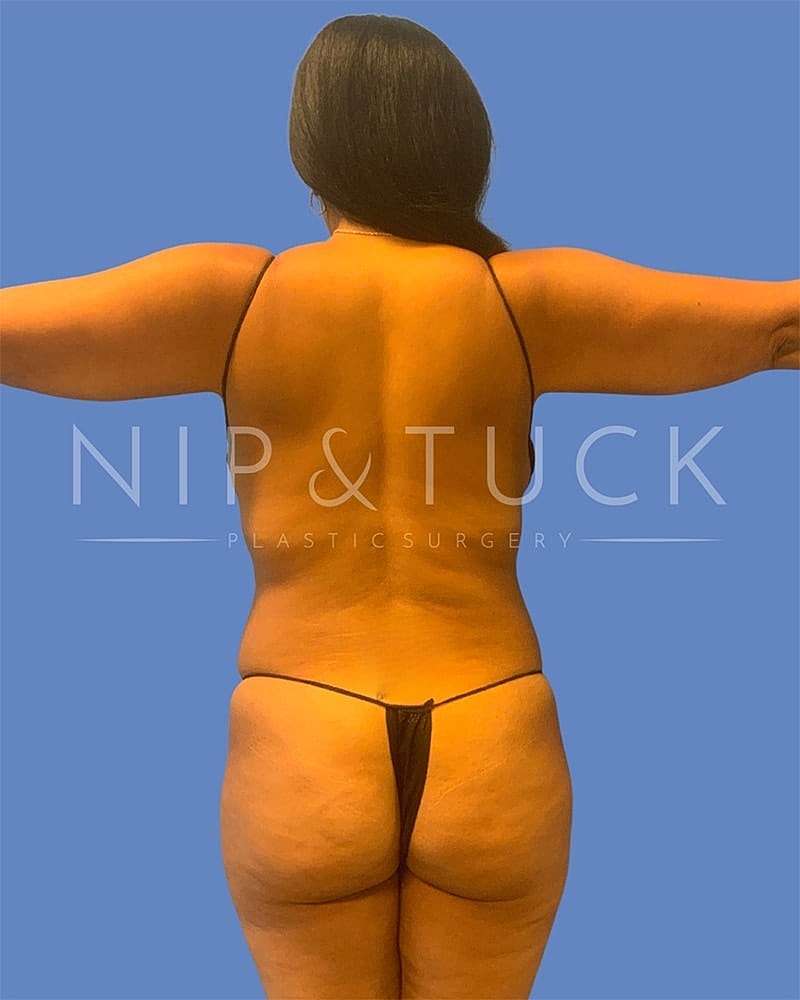 Mommy Makeover Before & After