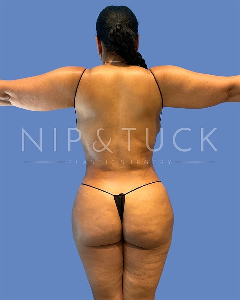 Mommy Makeover Before & After