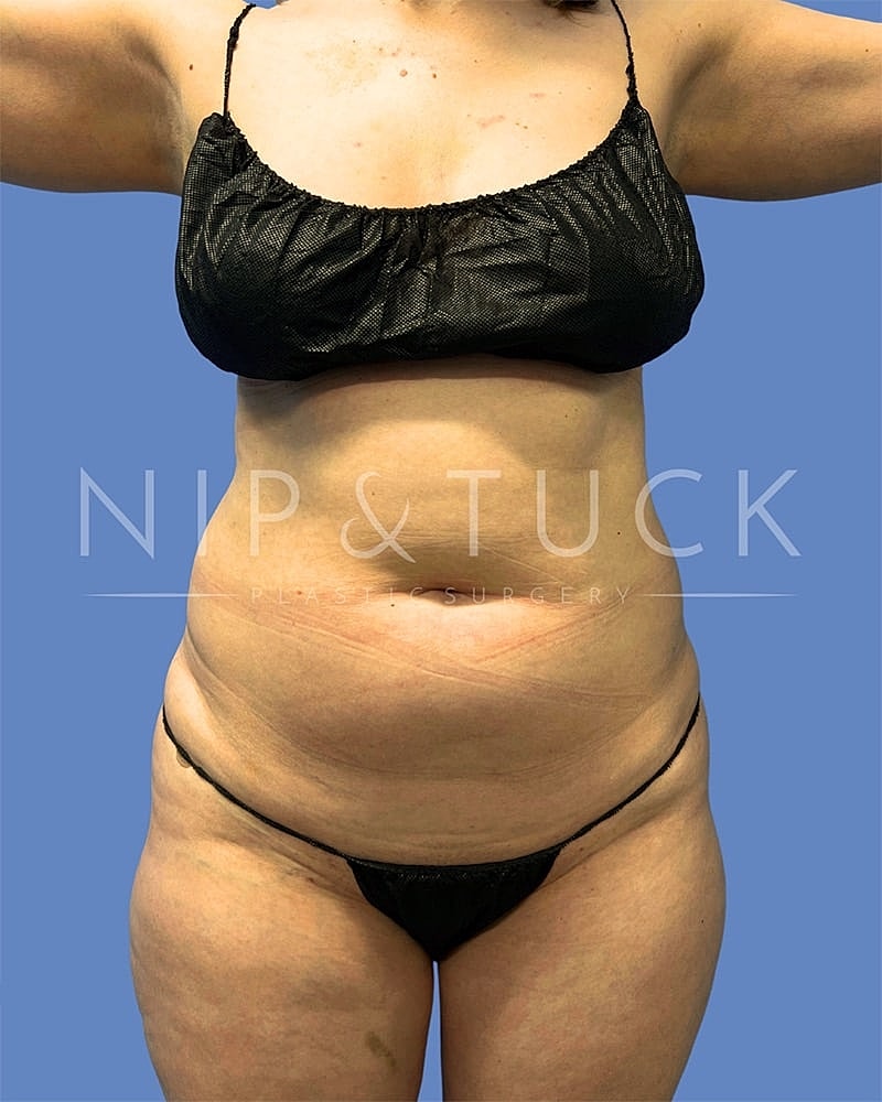 Mommy Makeover Before & After