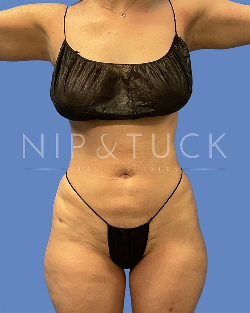 Mommy Makeover Before & After