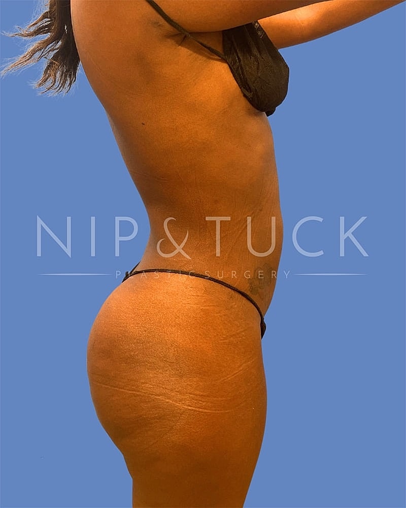 Mommy Makeover Before & After