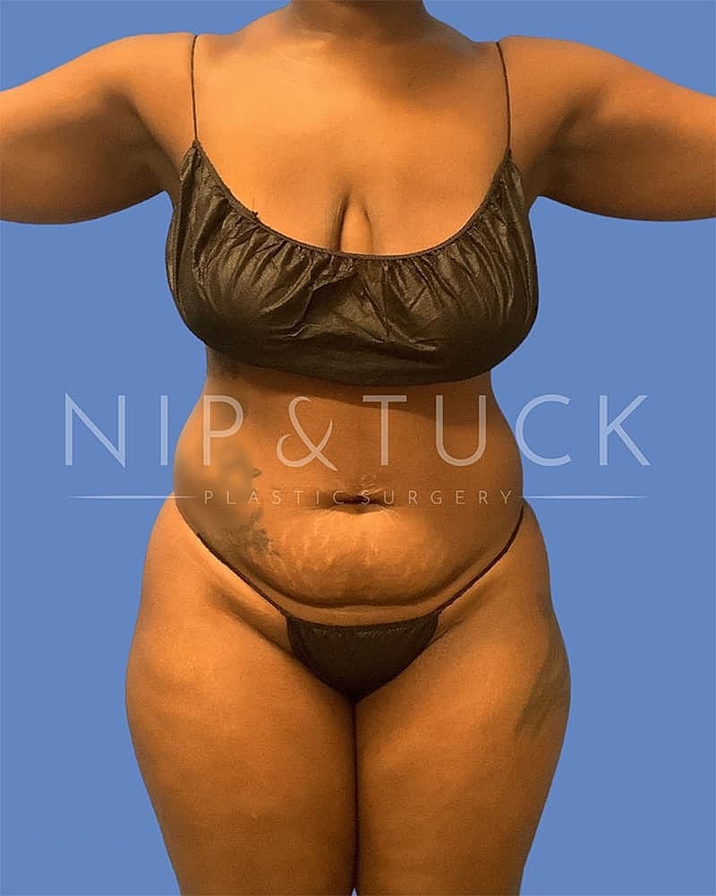 Mommy Makeover Before & After