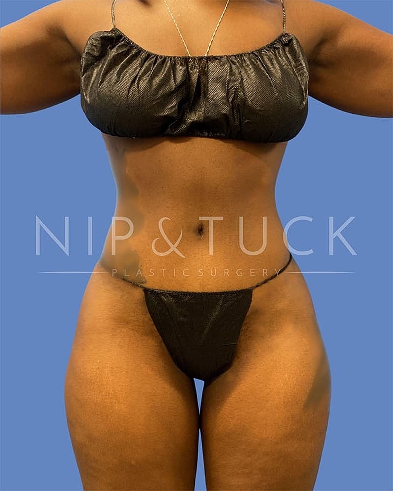 Mommy Makeover Before & After