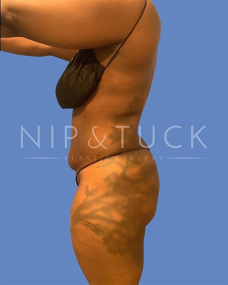 Mommy Makeover Before & After