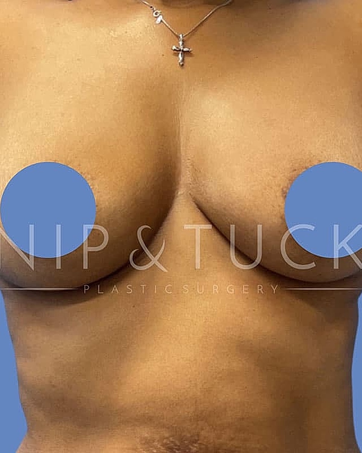 Before and after plastic surgery photo.