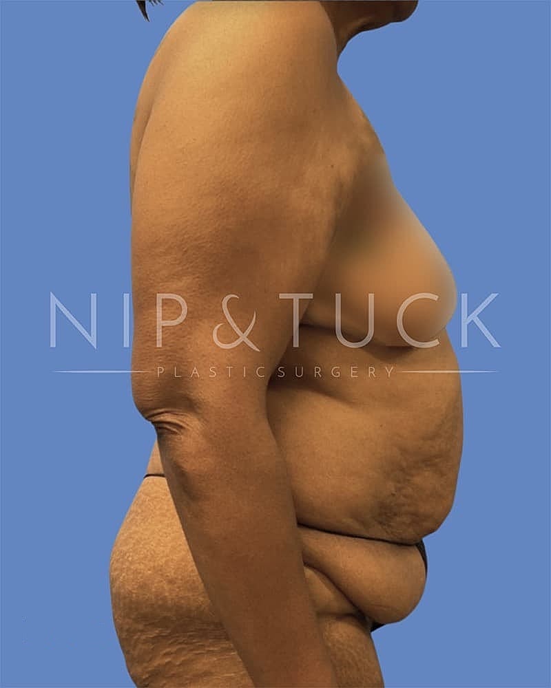 Mommy Makeover Before & After