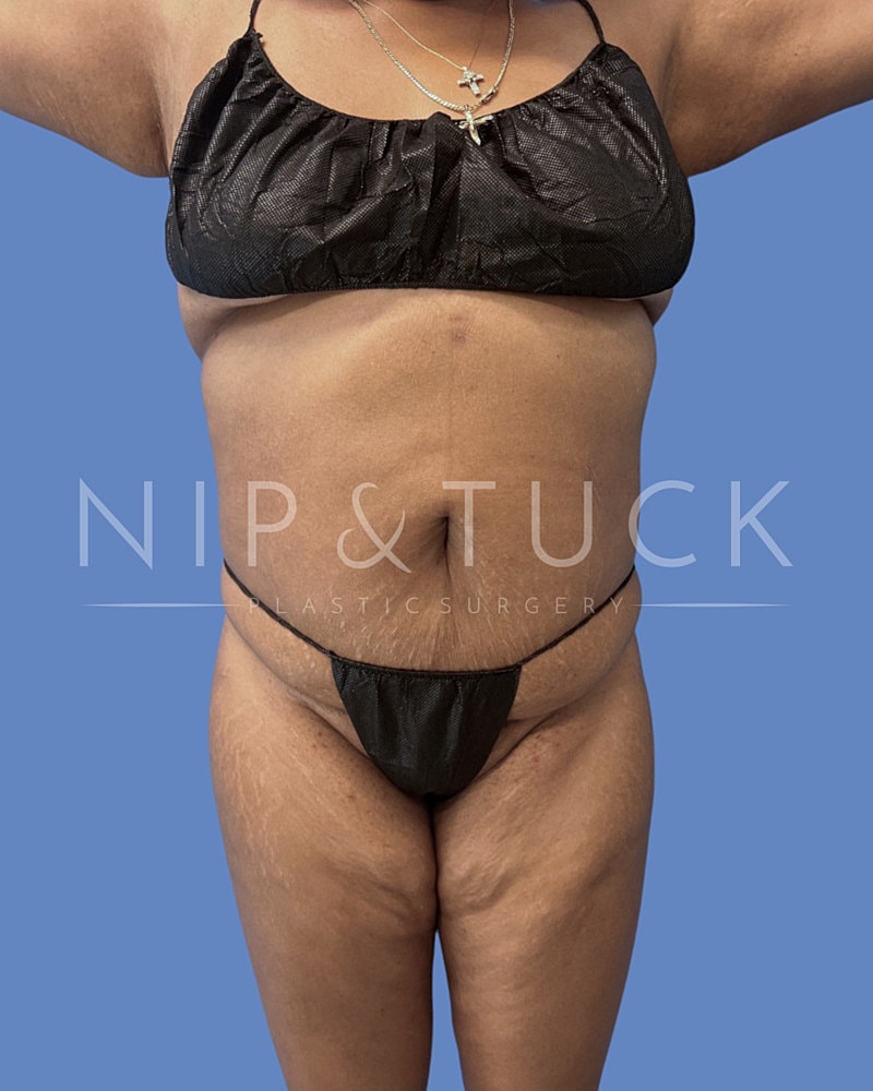 Skin Tightening Before & After