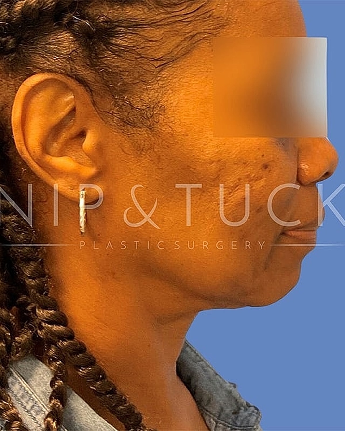 Skin Tightening Before & After