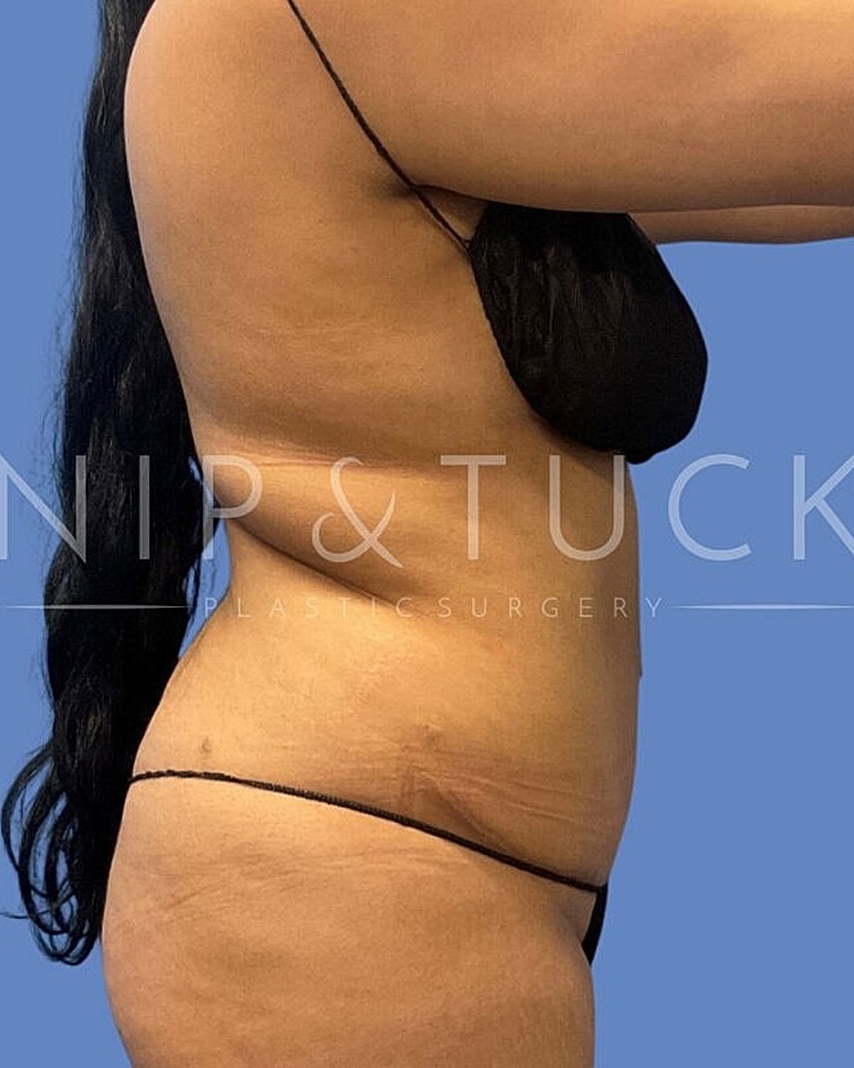 Skin Tightening Before & After