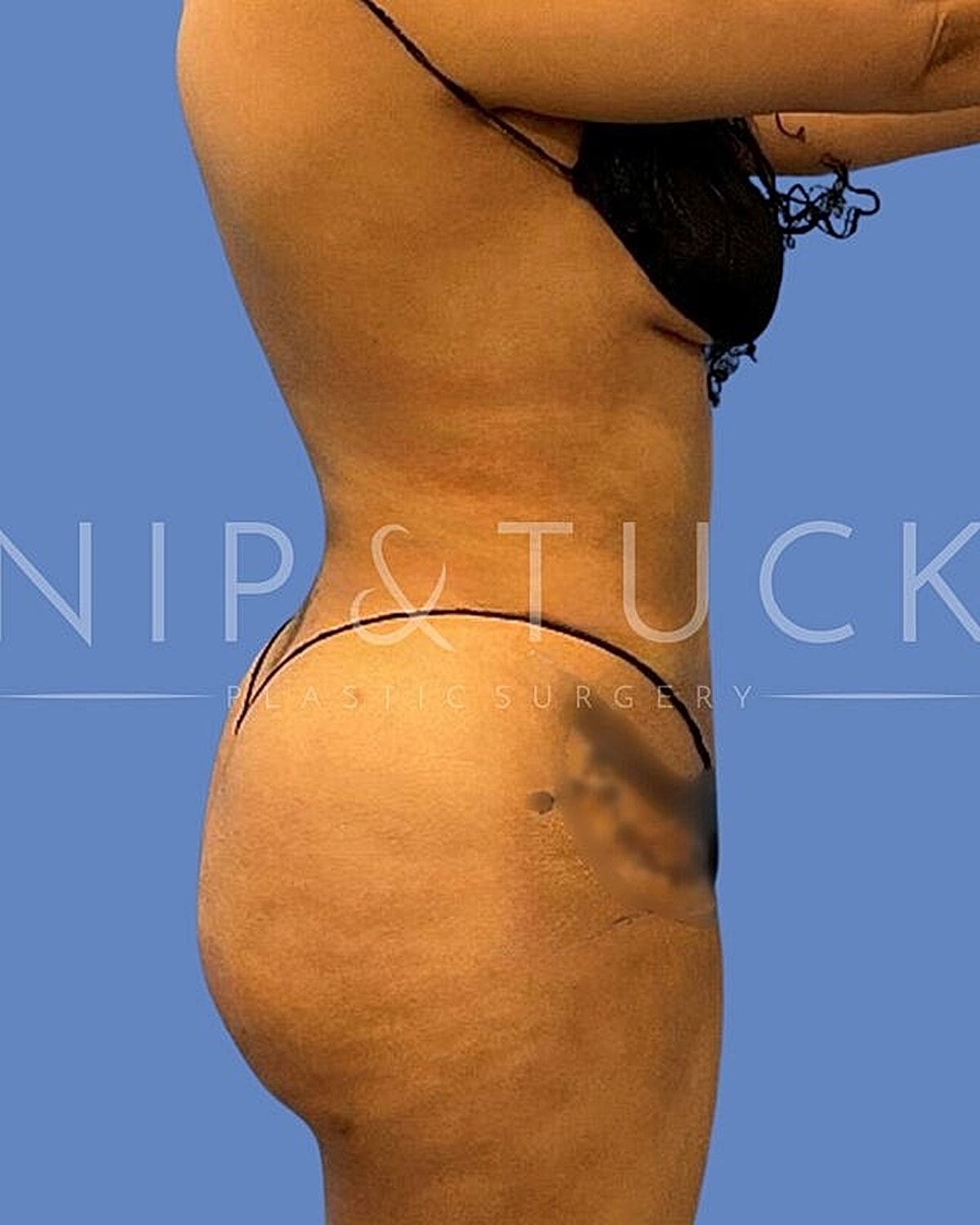 Skin Tightening Before & After