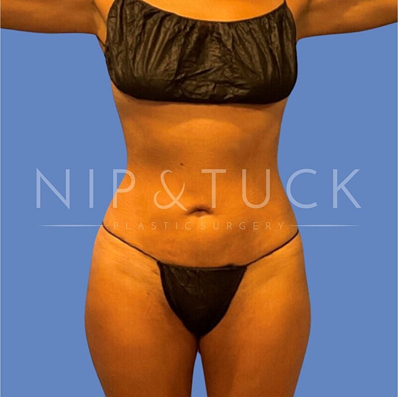 Skin Tightening Before & After