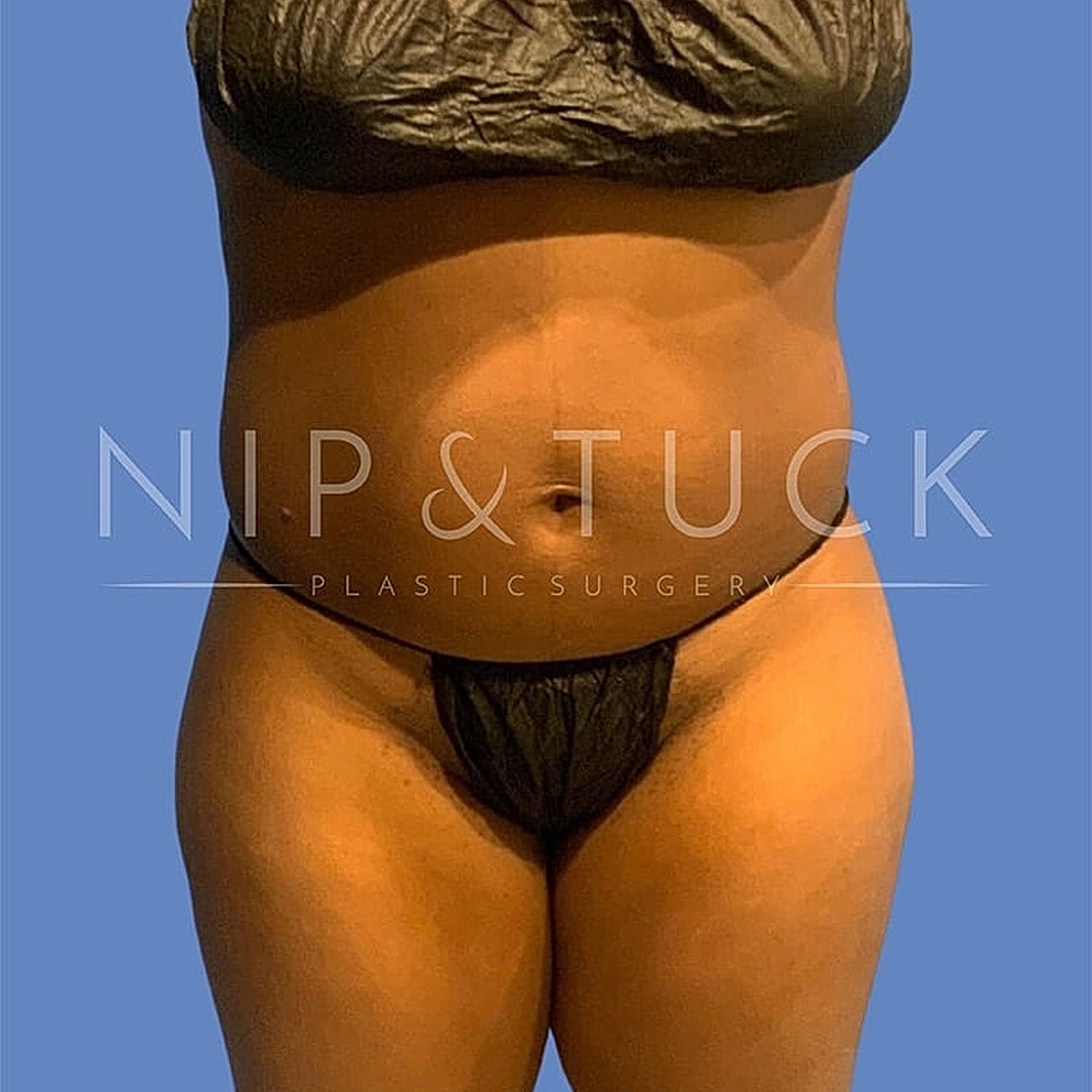 Skin Tightening Before & After