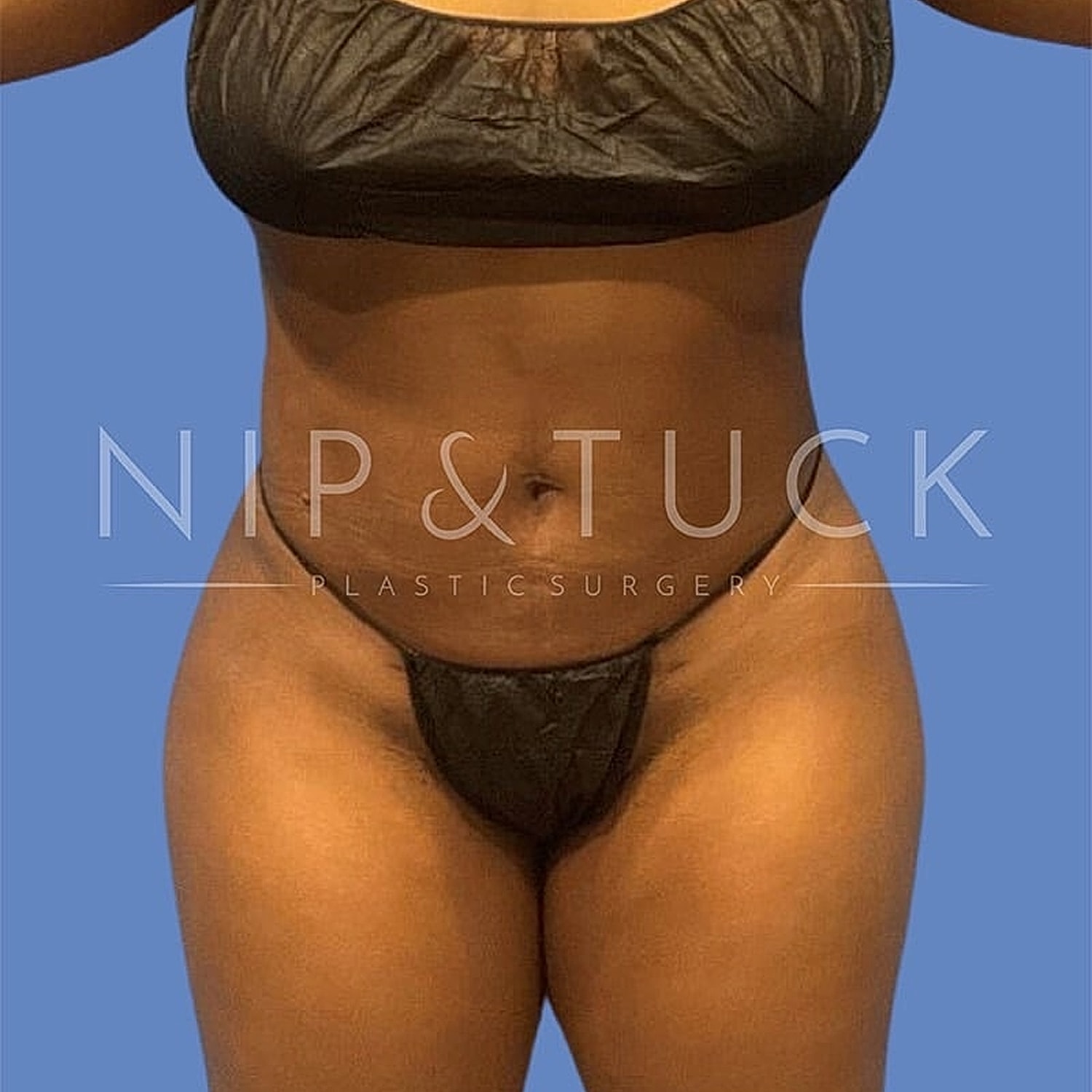 Skin Tightening Before & After