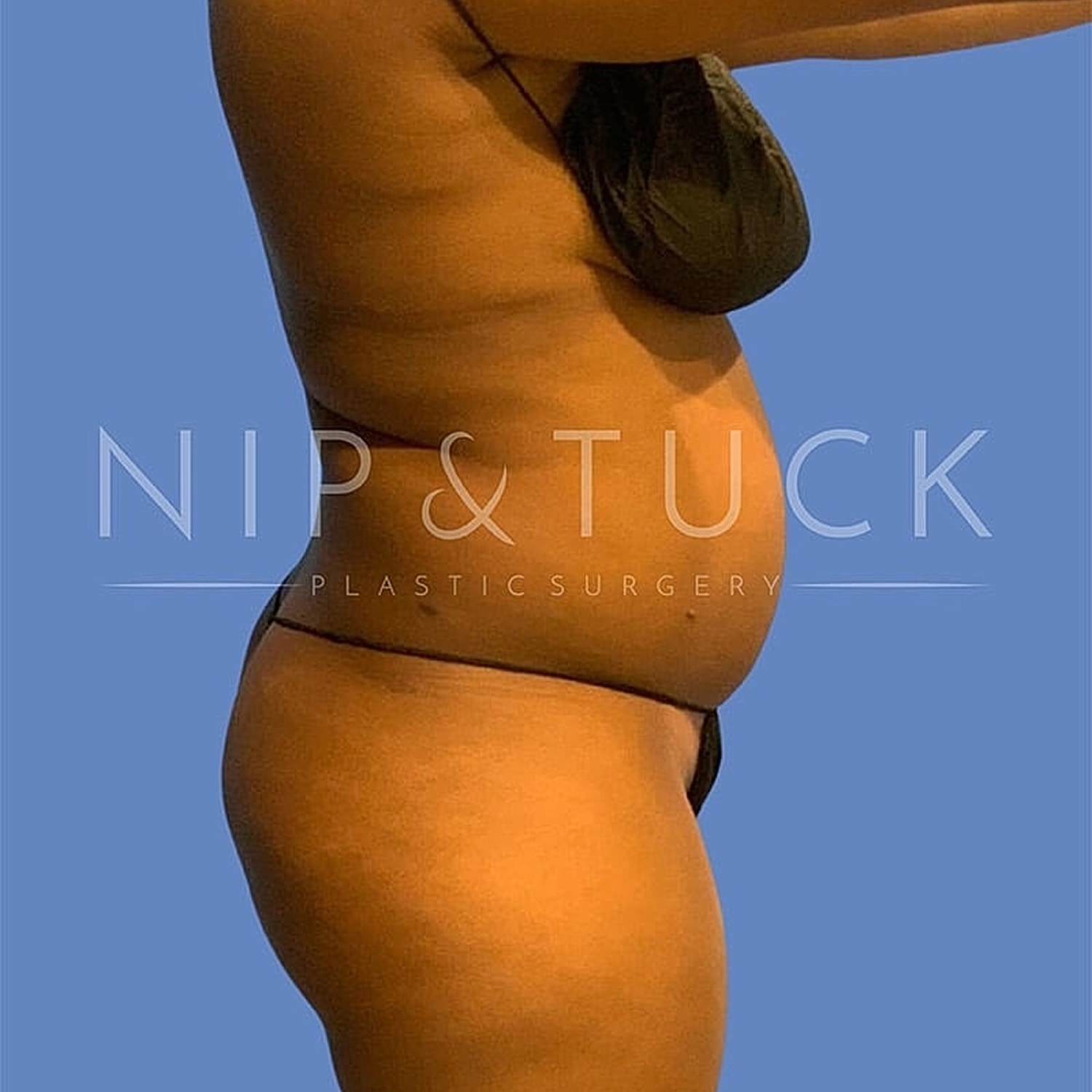 Skin Tightening Before & After