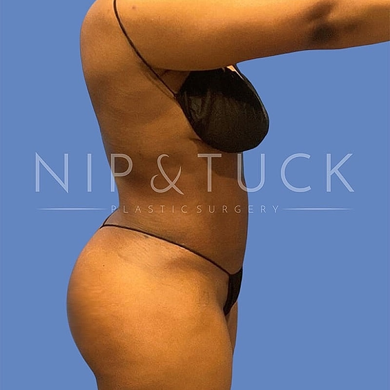 Skin Tightening Before & After