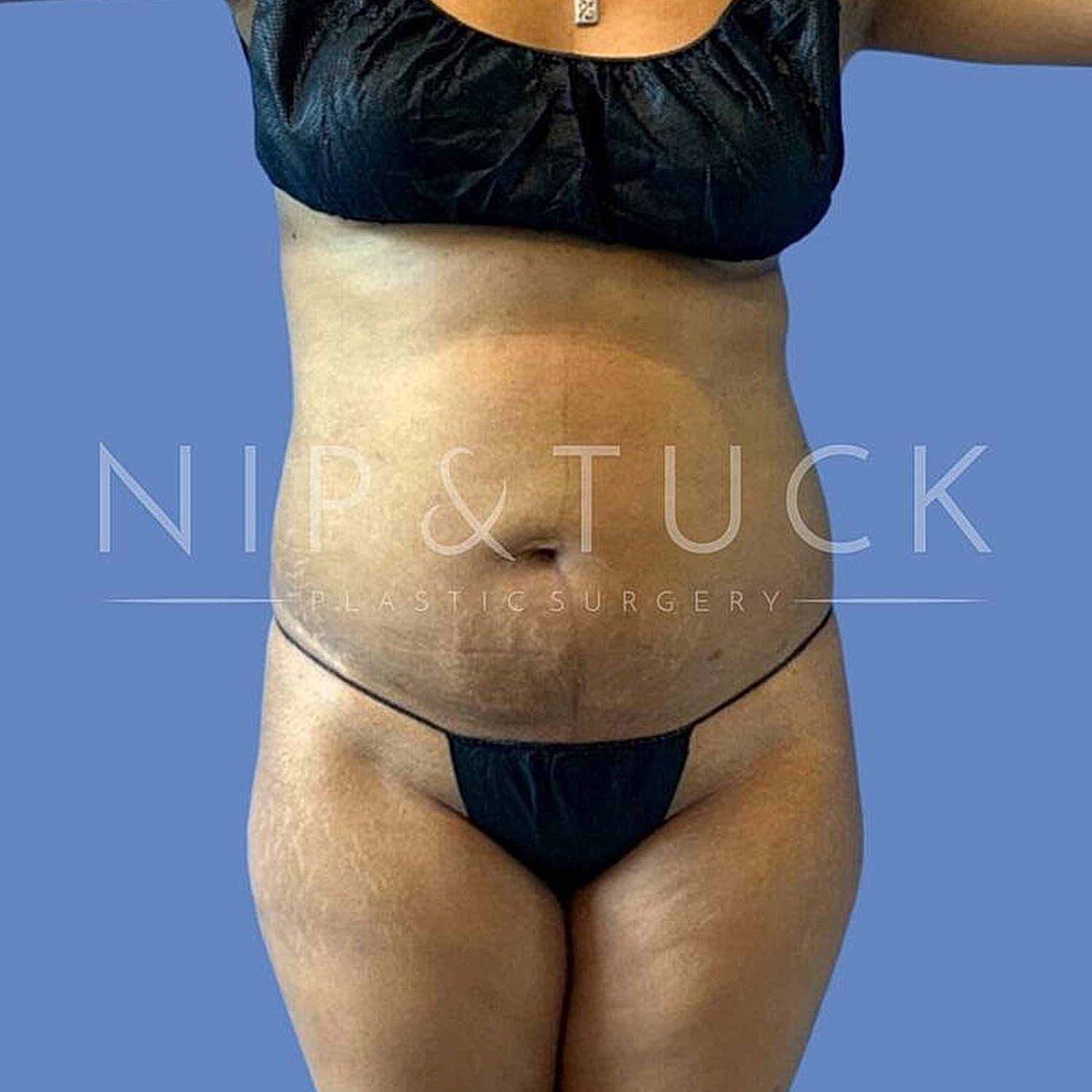 Skin Tightening Before & After