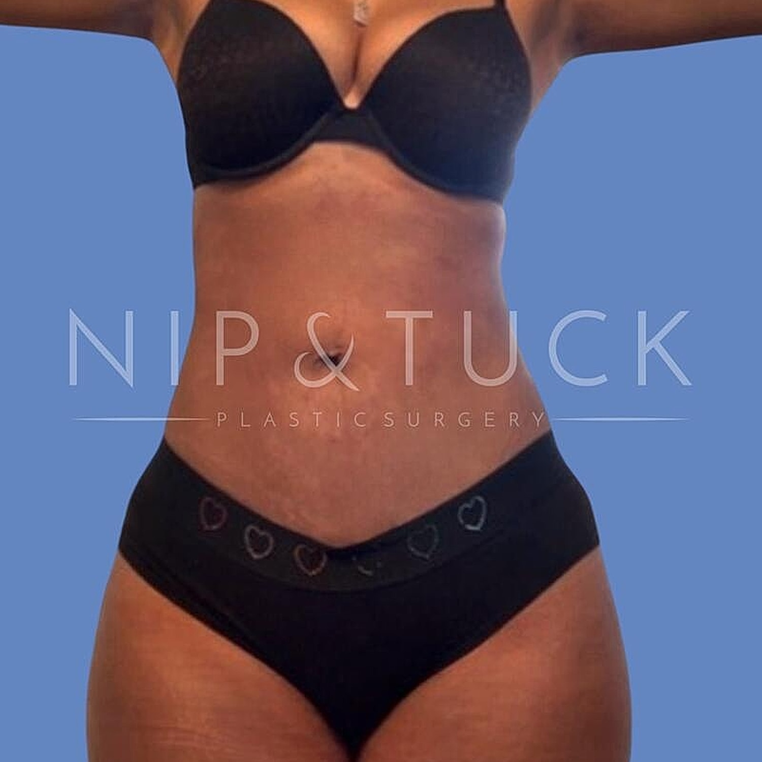 Skin Tightening Before & After