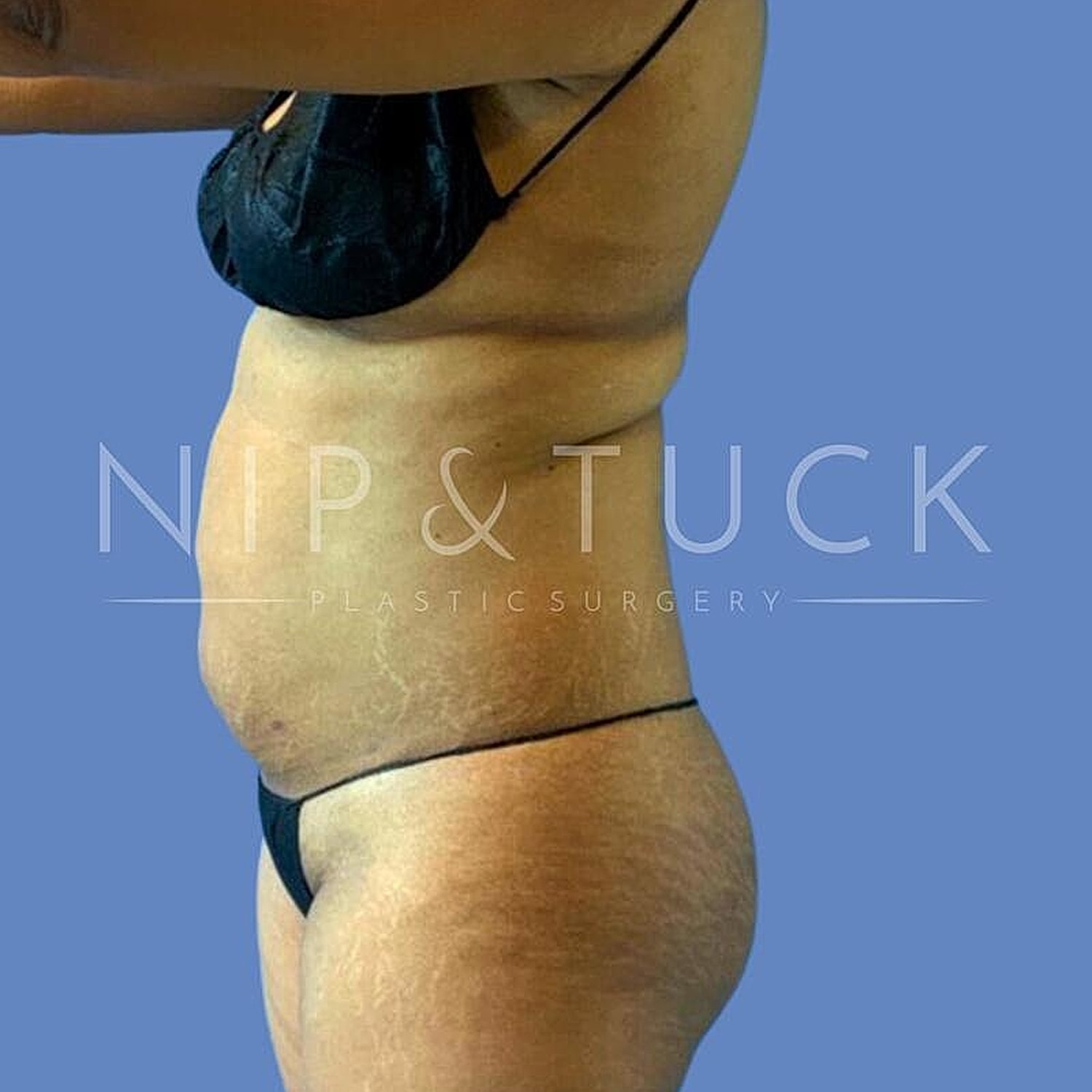 Skin Tightening Before & After