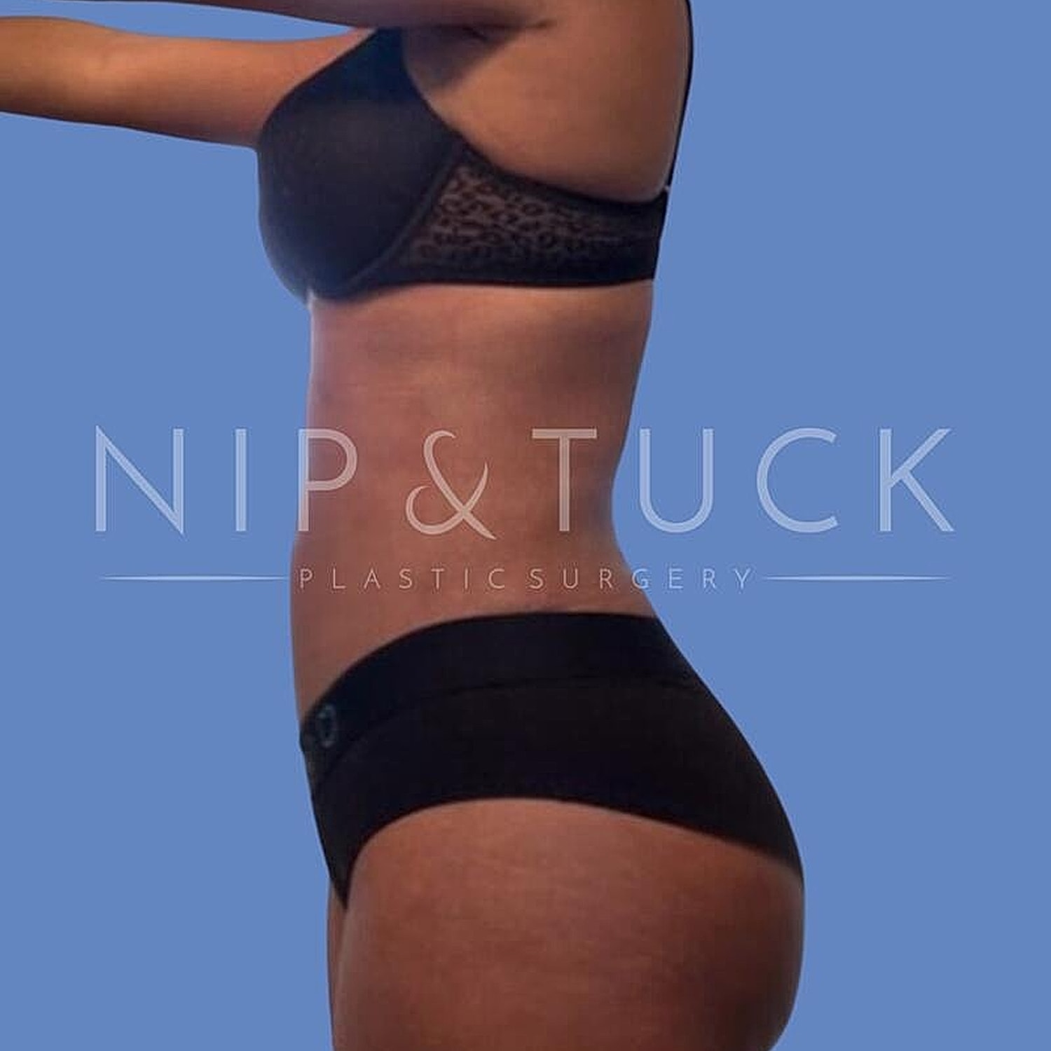 Skin Tightening Before & After