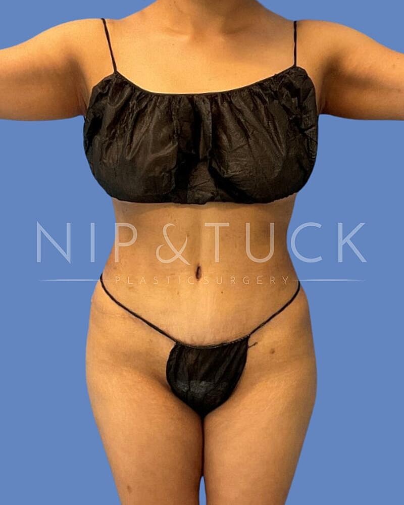 Skin Tightening Before & After