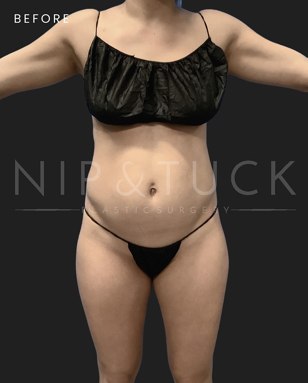 Renuvion Skin Tightening Before & After