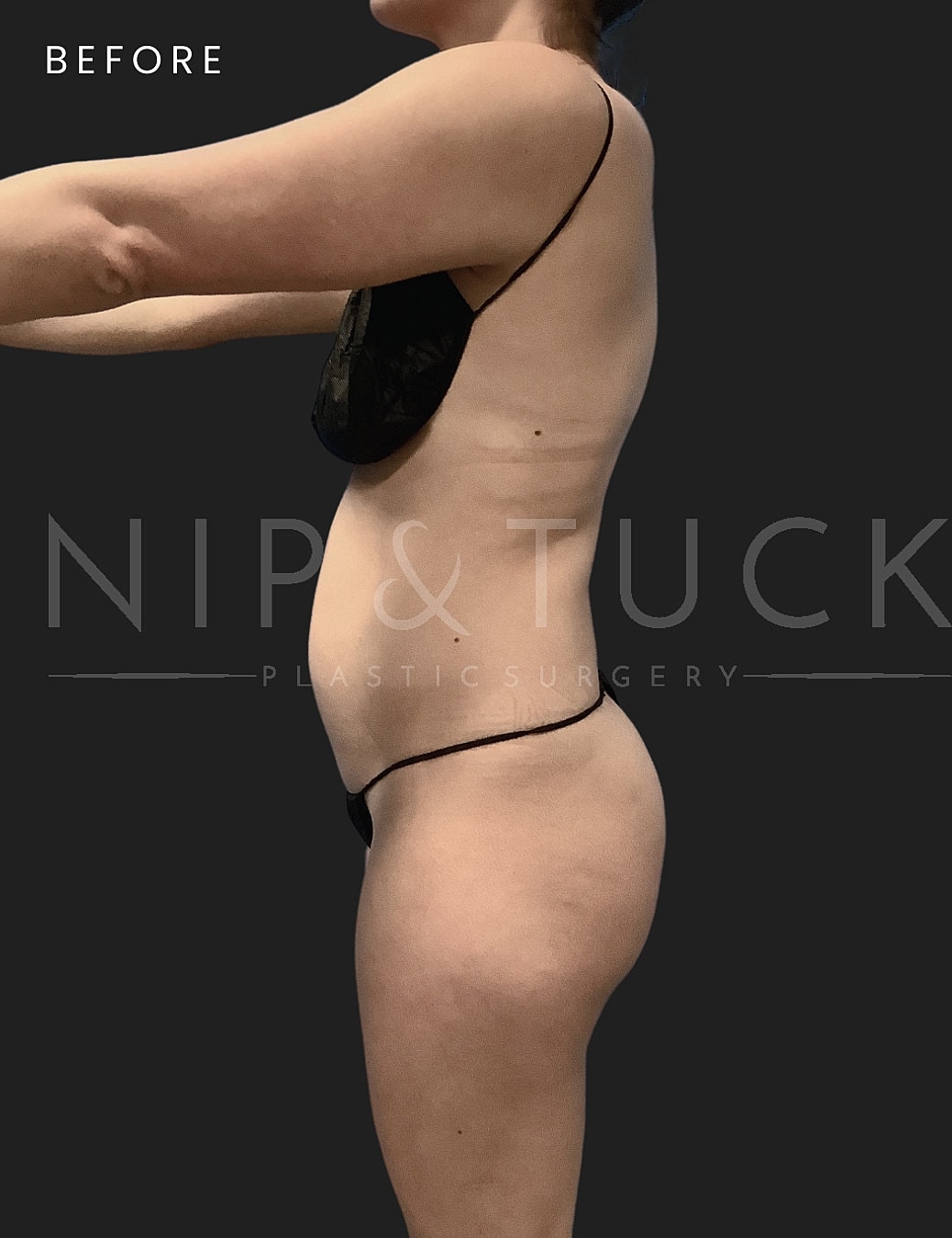 Renuvion Skin Tightening Before & After