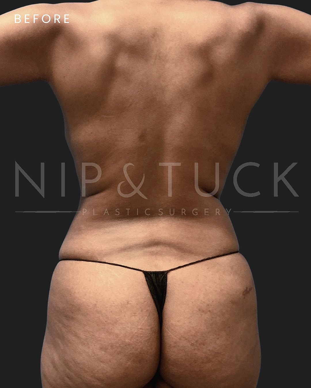 Renuvion Skin Tightening Before & After
