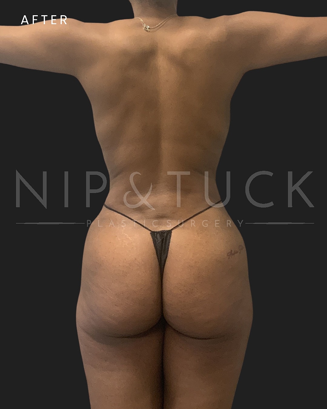 Renuvion Skin Tightening Before & After
