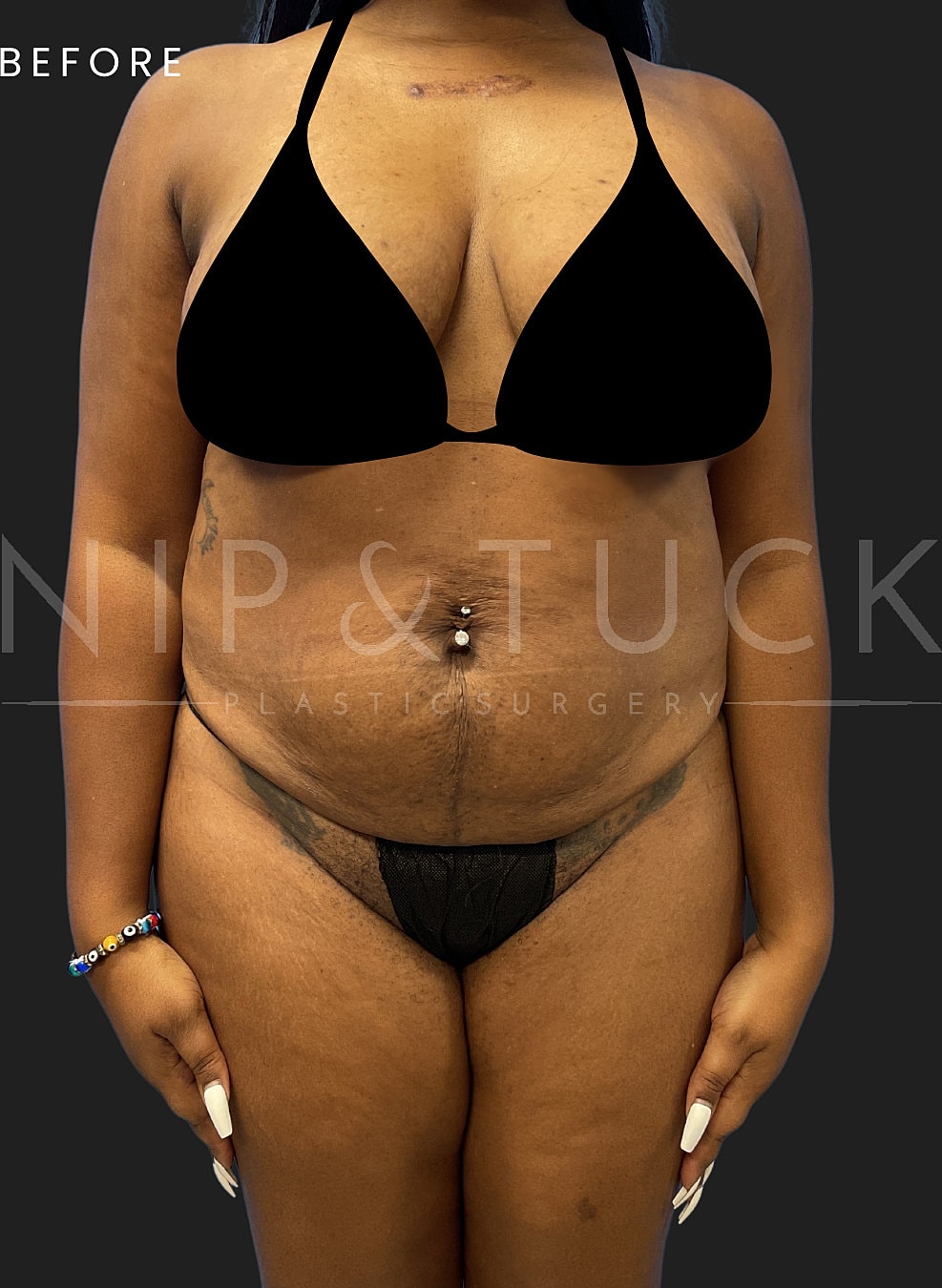 Renuvion Skin Tightening Before & After
