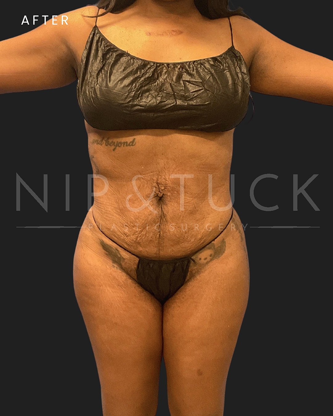 Renuvion Skin Tightening Before & After