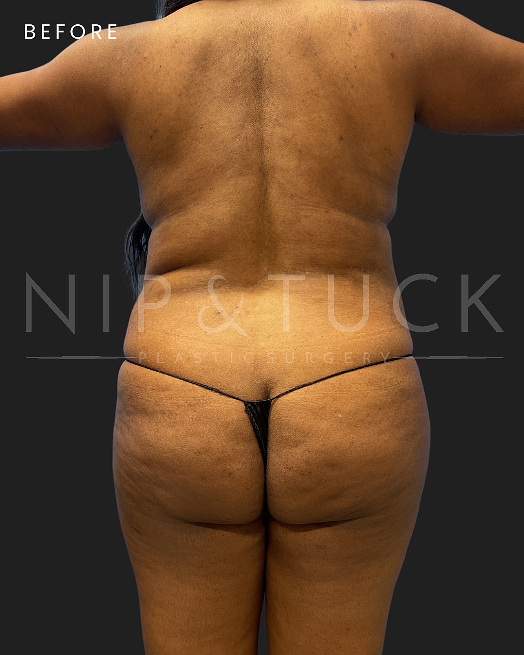 Renuvion Skin Tightening Before & After