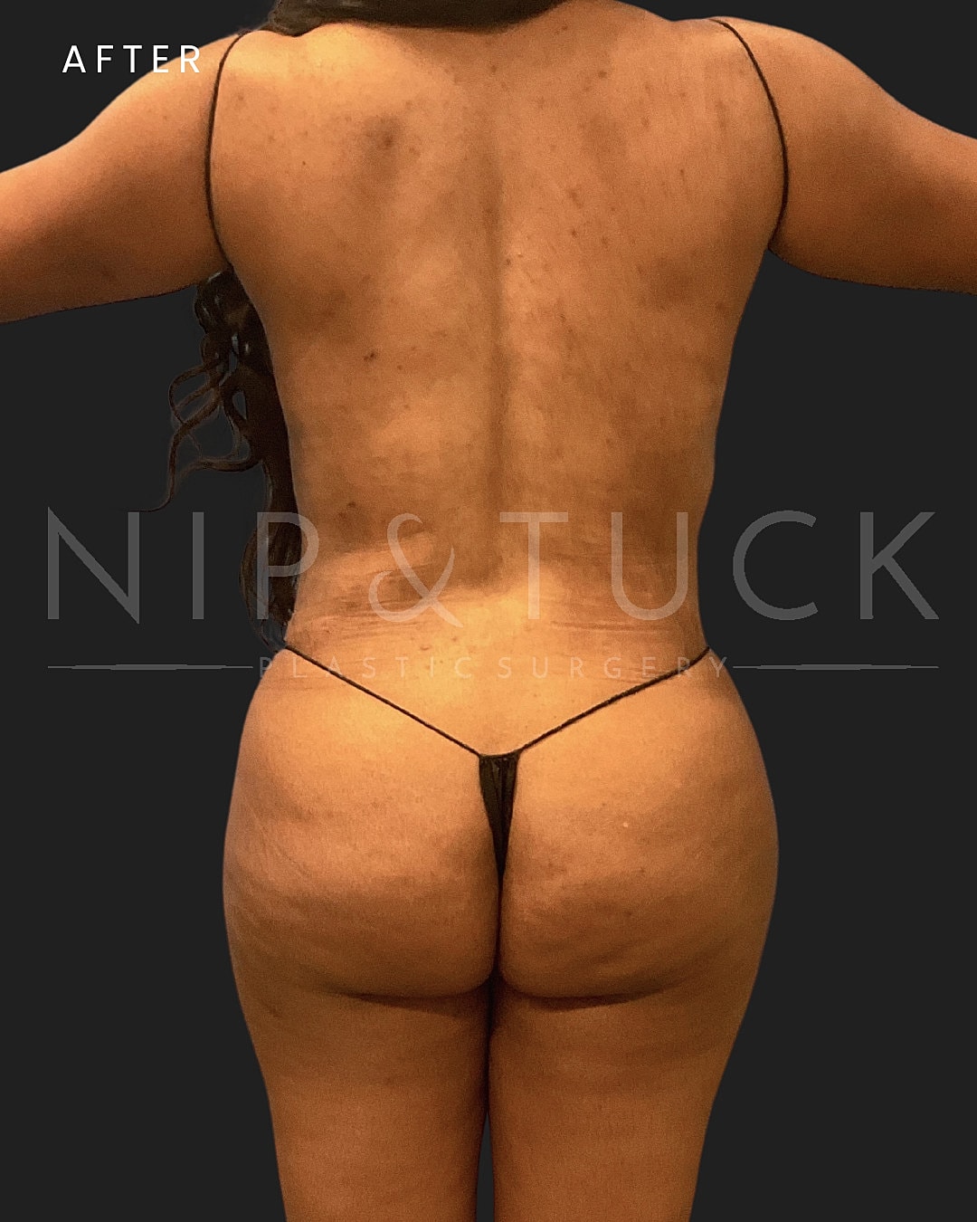 Renuvion Skin Tightening Before & After