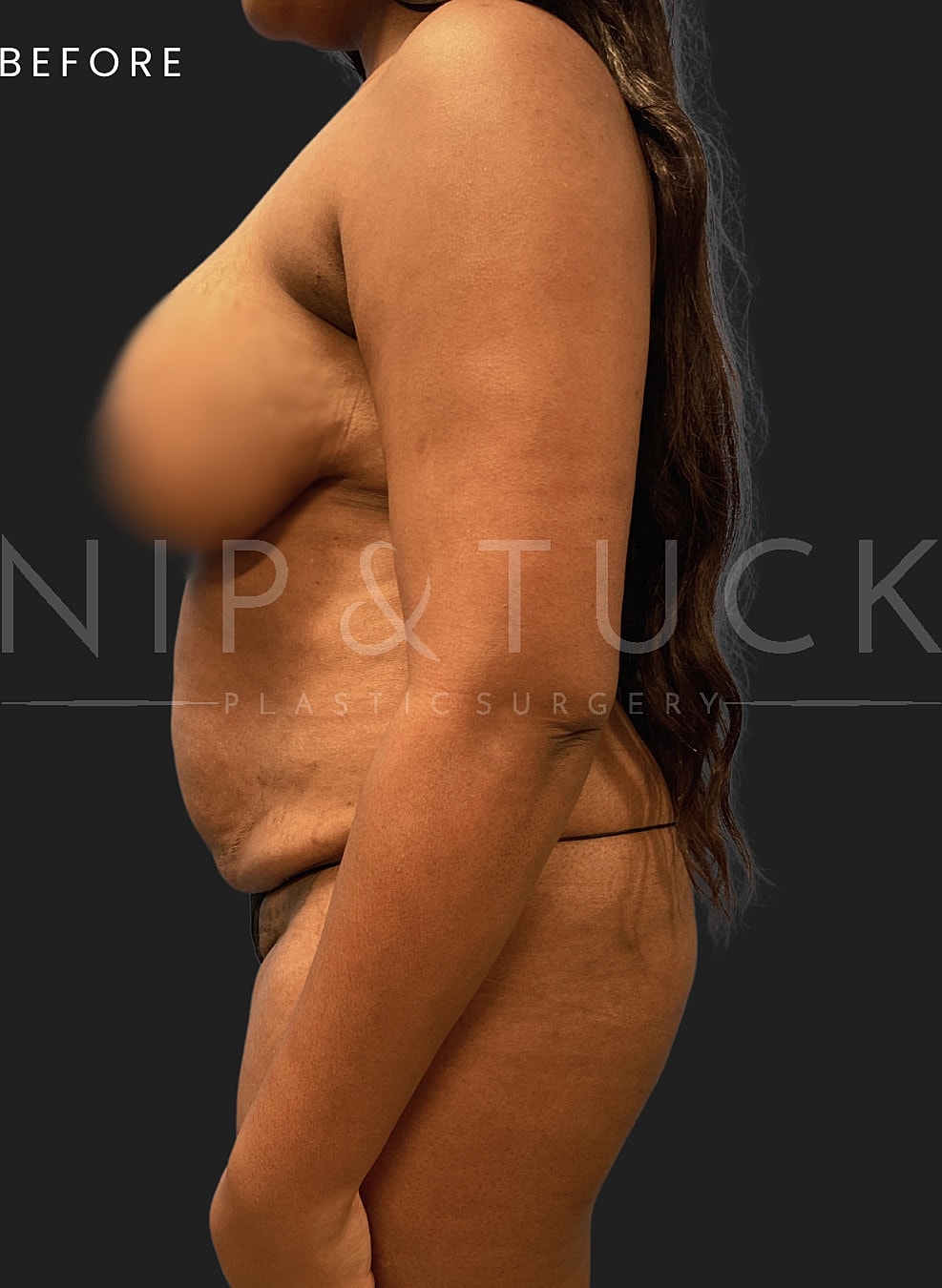 Renuvion Skin Tightening Before & After