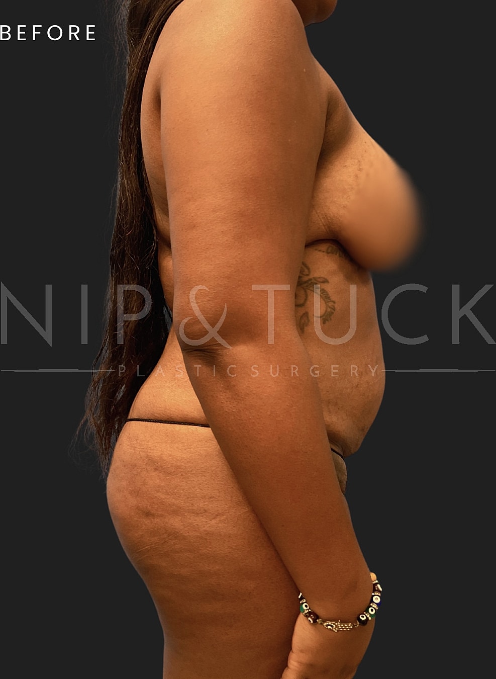 Renuvion Skin Tightening Before & After