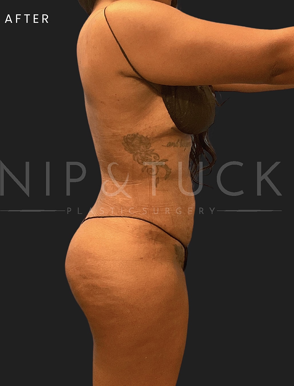 Renuvion Skin Tightening Before & After