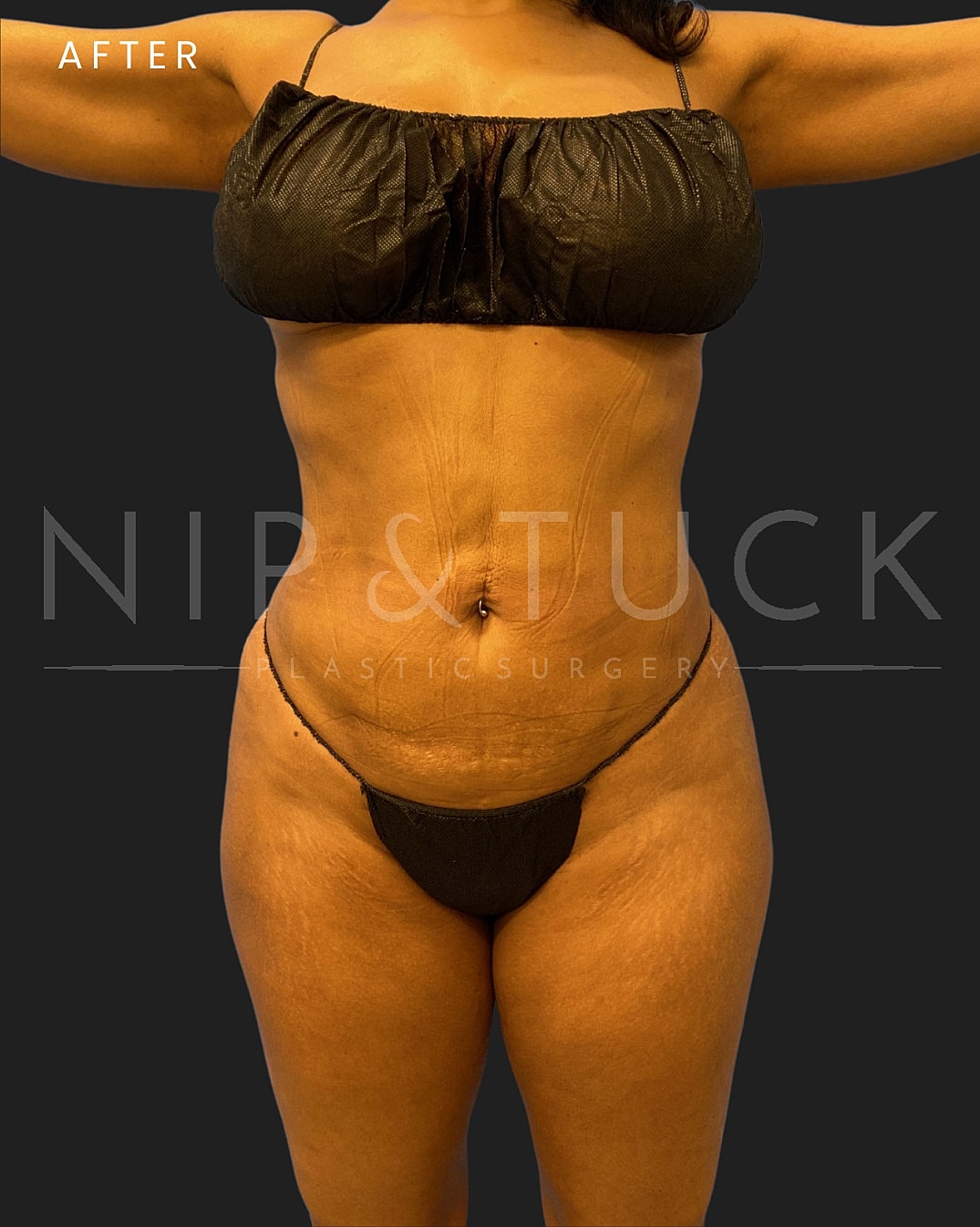 Renuvion Skin Tightening Before & After