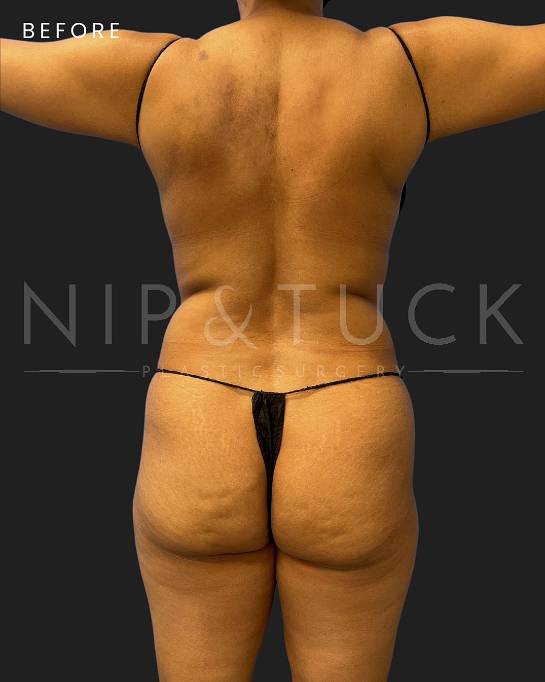 Renuvion Skin Tightening Before & After