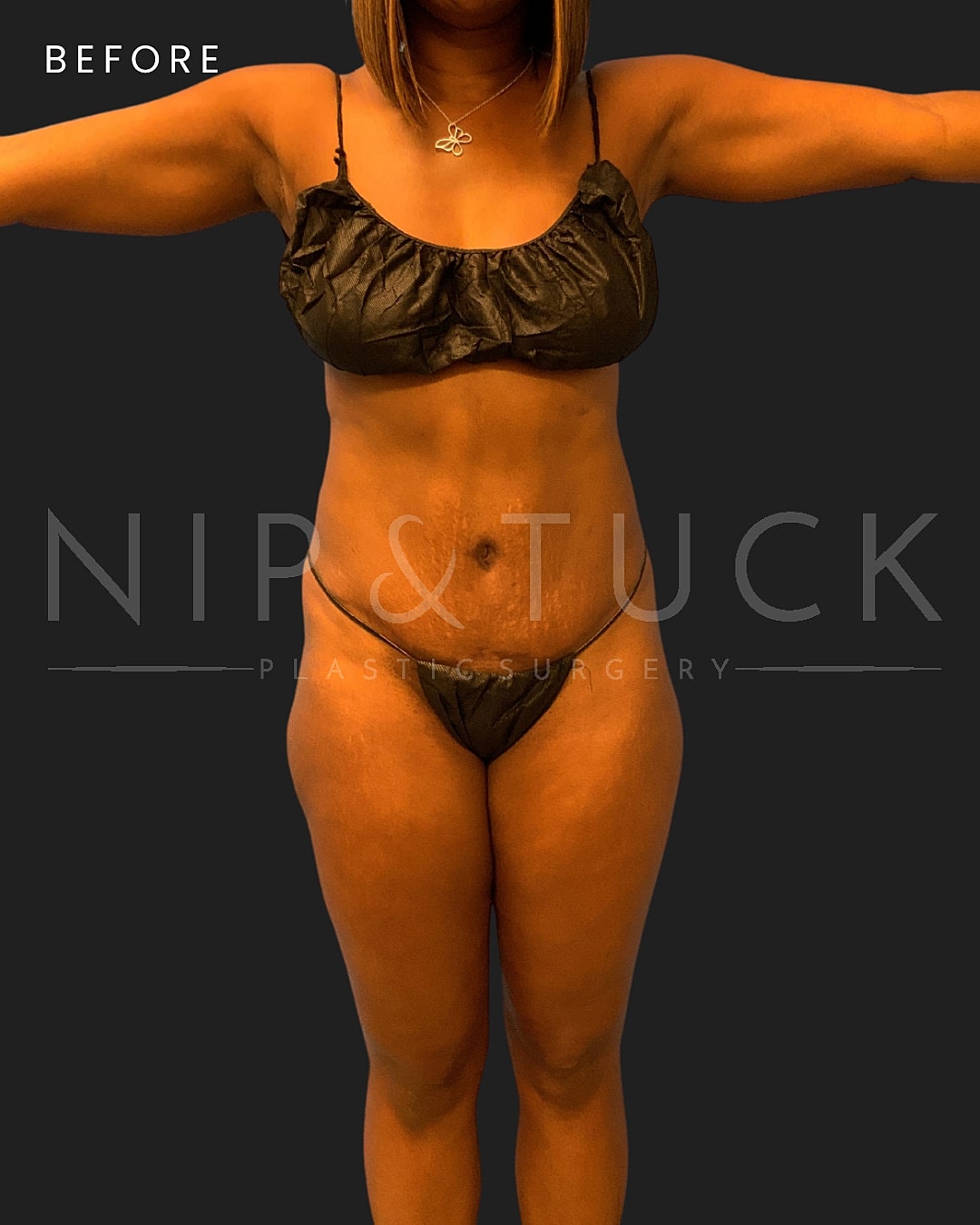 Renuvion Skin Tightening Before & After