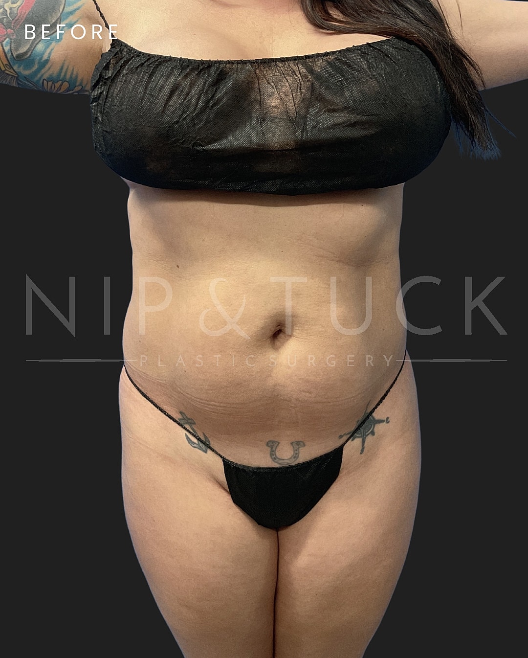 Renuvion Skin Tightening Before & After