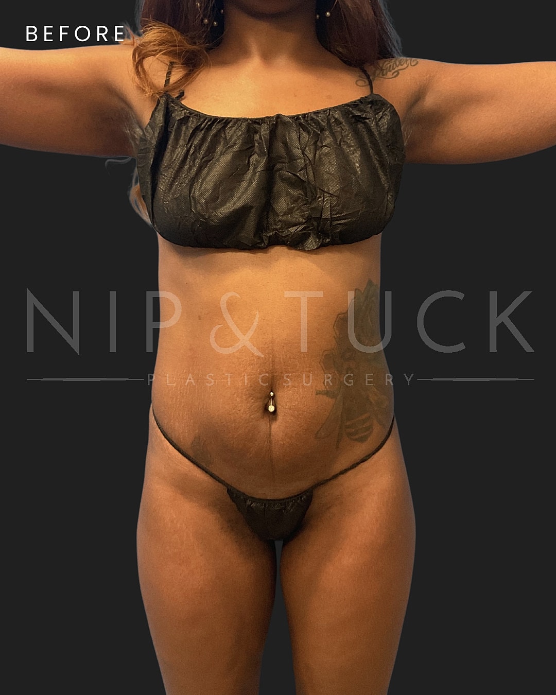 Renuvion Skin Tightening Before & After