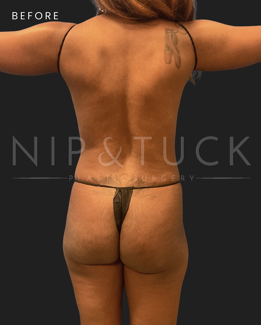 Renuvion Skin Tightening Before & After