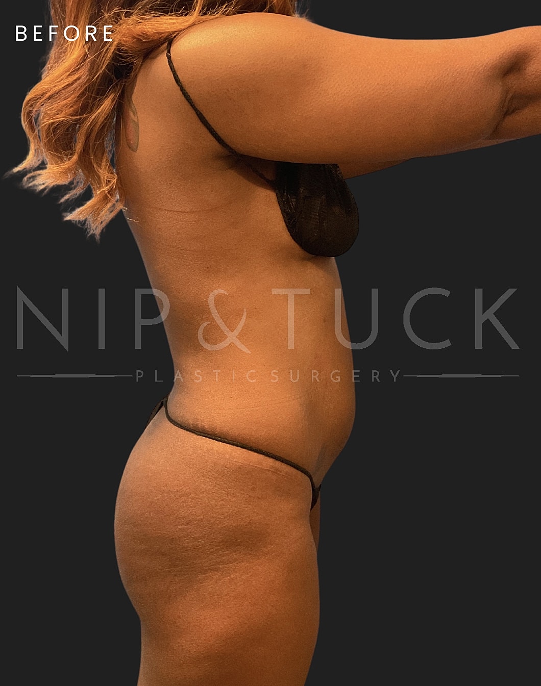 Renuvion Skin Tightening Before & After