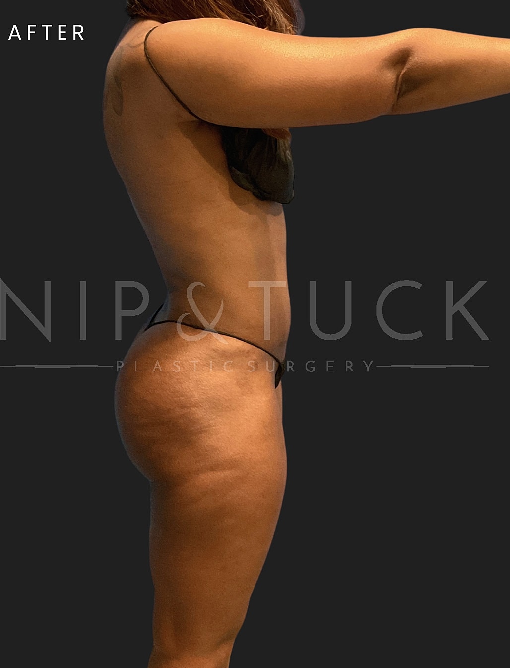 Renuvion Skin Tightening Before & After