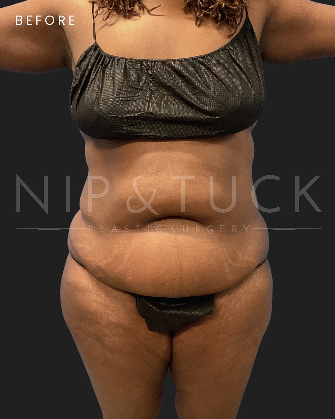 Renuvion Skin Tightening Before & After