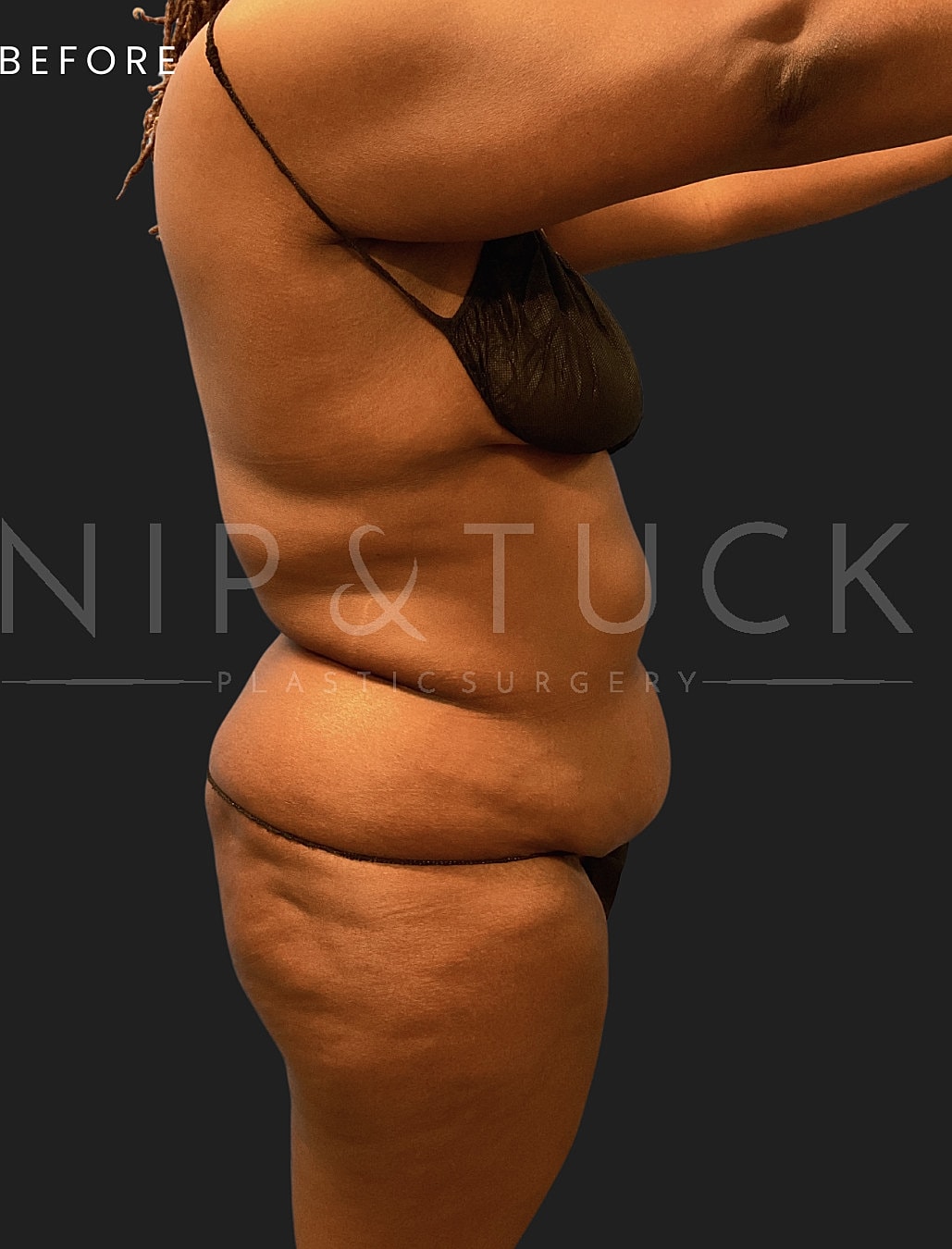 Renuvion Skin Tightening Before & After