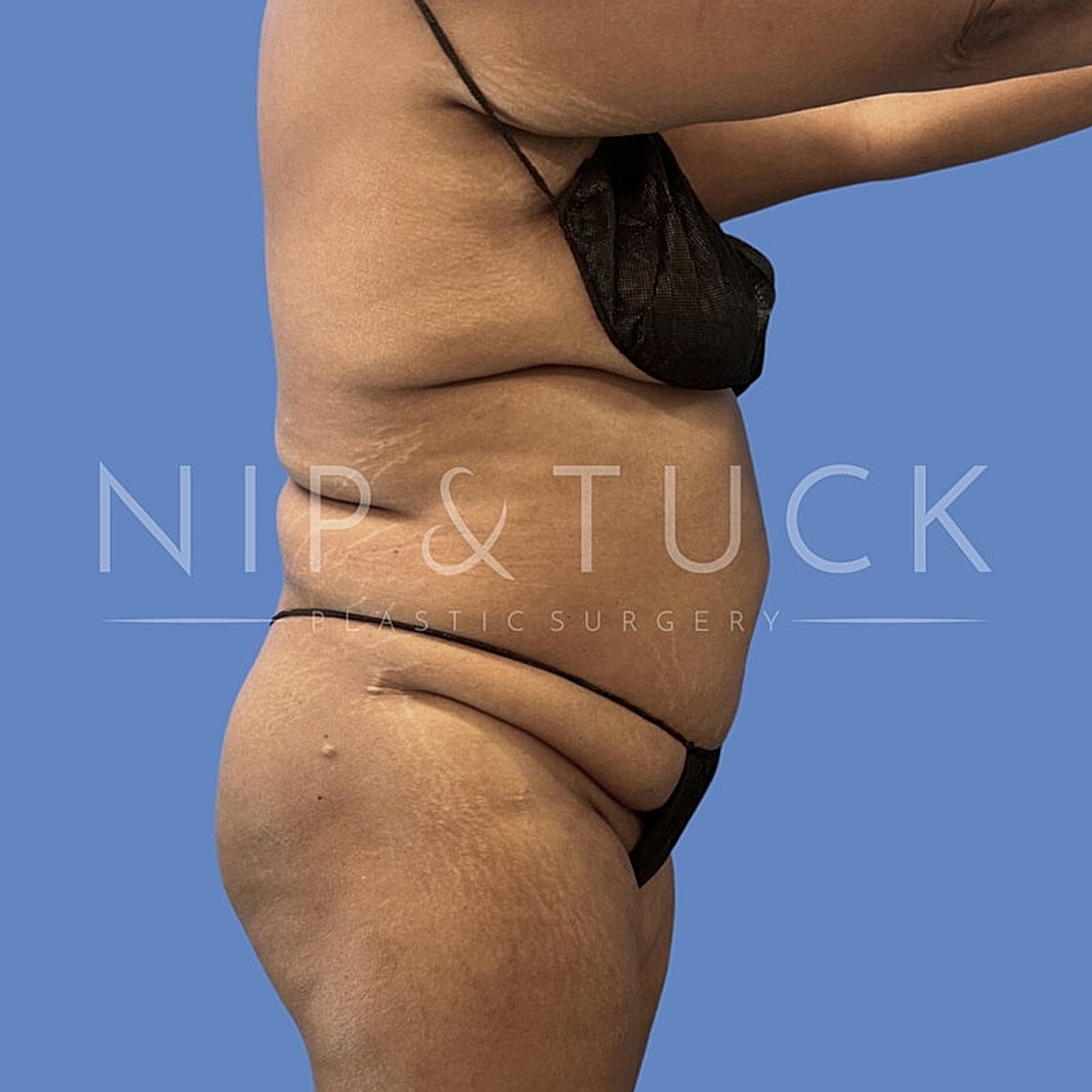 Side view of individual with body contouring.